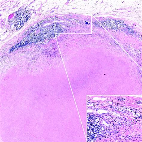 Microscopic View Of The Lymph Node Reveals A Small Number Of Metastatic