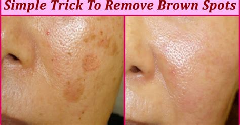 Simple Trick To Remove Brown Spots From Your Skin - TOP 5 DIY