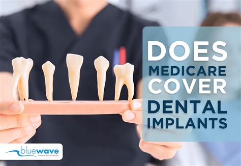 Does Ups Insurance Cover Dental Implants At Jessie Roland Blog