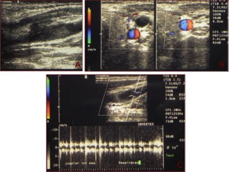 Us Doppler Of A Man With Deep Venous Thrombosis In The Left Internal