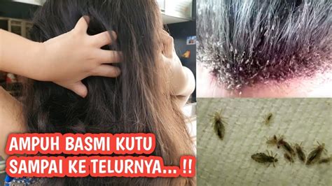 Cara Nak Hilangkan Kutu Rambut Secara Semulajadi Charles Poole