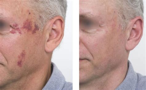 Antes E Depois Do Tratamento A Laser Contra Rosácea Clínica De