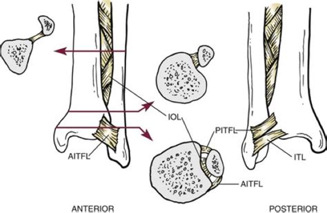 Syndesmotic Instability - David Shepherd