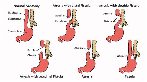 Tracheoesophageal Fistula In Adults