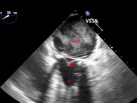 Intraoperative Transesophageal Echocardiography Showing A Latd There