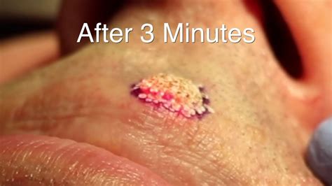 Laser Mole Removal Upper Lip Youtube