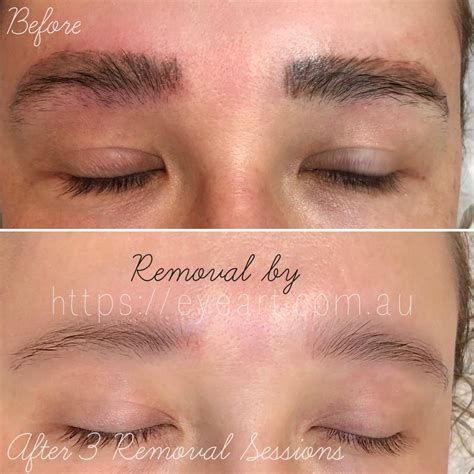 Eyebrow Tattoo Removal Melbourne, Victoria - Eye Art Studio