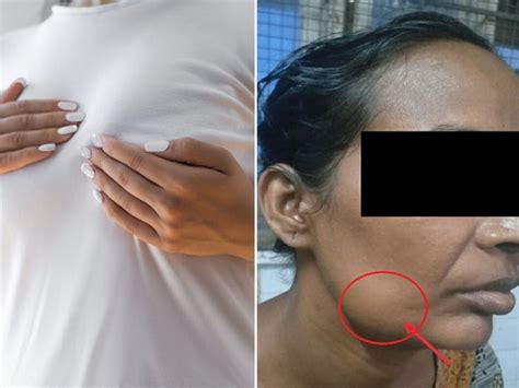 Woman With Swollen Jaw Diagnosed With Breast Cancer - Business Insider