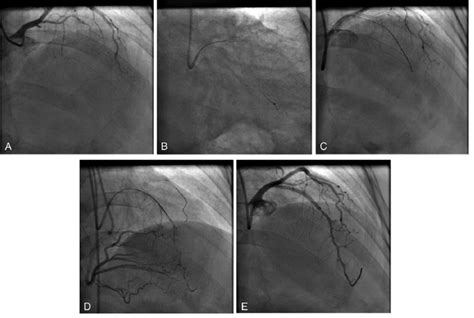 Procedure of a left anterior descending artery (LAD) in-stent CTO using ...