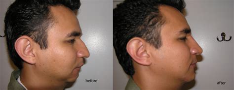 Rhinoplasty Is Becoming A Popular Technique To Get The Desired Nose