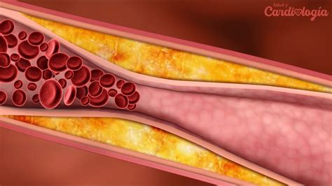 Funcionamiento y obstrucción de las arterias del corazón YouTube