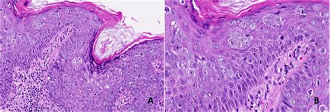 Photomicrographs Of The Skin Lesion From Case 2 Showing An