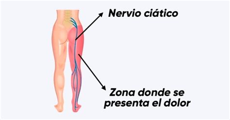 Cómo identificar y tratar el nervio ciático inflamado Tua Saúde