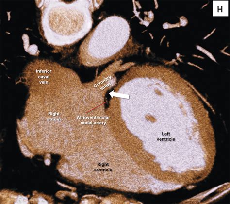 Atrioventricular Septal Region Radiology Key