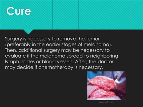 PPT - Desmoplastic Melanoma PowerPoint Presentation, free download - ID ...