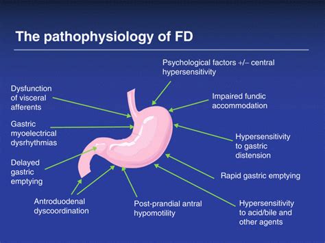 Dyspepsia | Abdominal Key