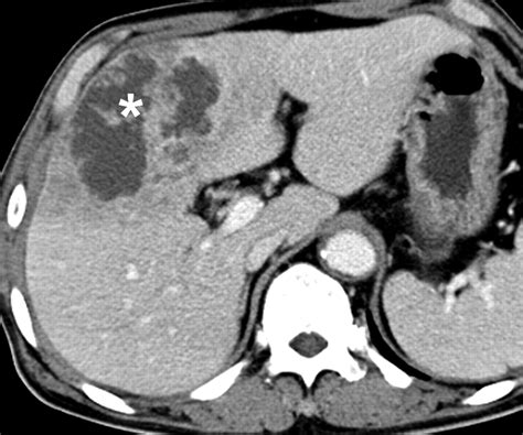 The Perihepatic Space Comprehensive Anatomy And Ct Features Of