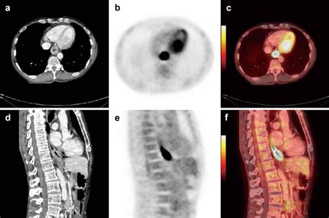 Determination Of Radiotherapy Target Volume For Esophageal Cancer Liu