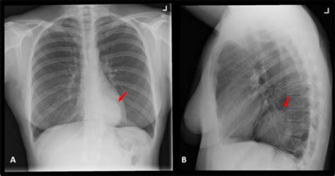 Chest X Ray A Posteroanterior And B Lateral Views Open I