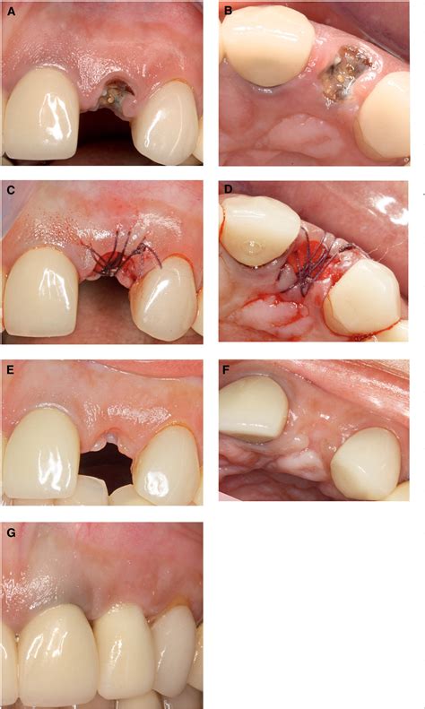 Healing Socket After Tooth Extraction