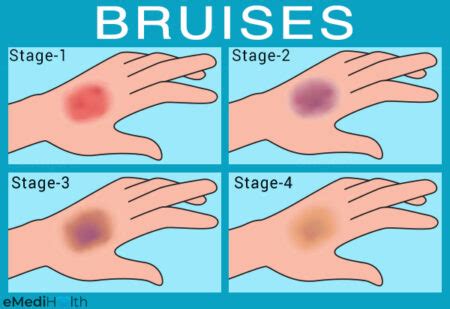 Possible Reasons And Risk Factors For Bruises Emedihealth