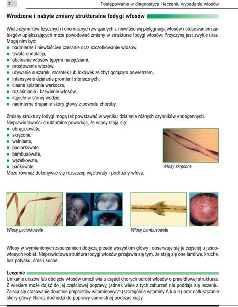 Post powanie w diagnostyce i leczeniu wypadania w osów PDF Darmowe