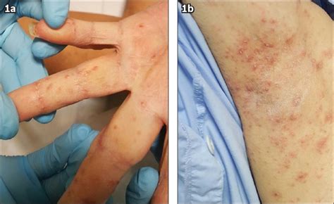 Beginning Stages Of Scabies