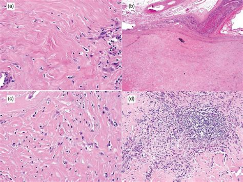 Ab Cft Demonstrating Hypocellular Proliferation Of Bland Spindle