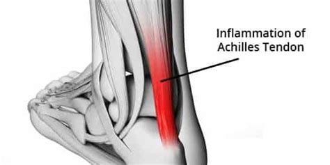 How To Diagnose Achilles Tendon Rupture Acorn Ultrasound Private Clinic