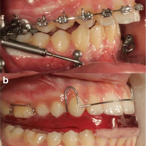 A Application Of Miniplate Anchored Forsus Fatigue Resistant Device