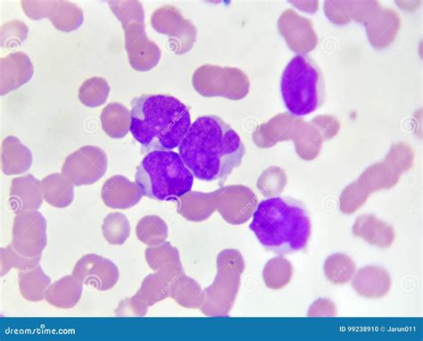 Acute Myeloid Leukemia Stock Photo Image Of Microscopy