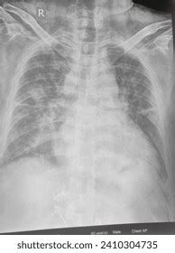 Chest X Ray Pa View Showed Bilateral Stock Photo Shutterstock