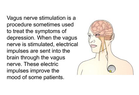 Patedu Vagus Nerve Stimulation Vns For Depression