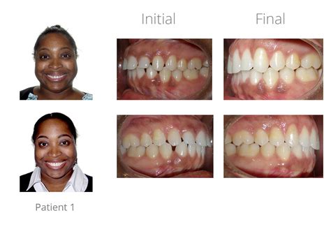 Gingivectomy/Crown Lengthening Before - Orthodontic Arts