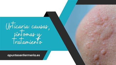 Urticaria Causas Síntomas Y Tratamiento Apuntes Enfermería