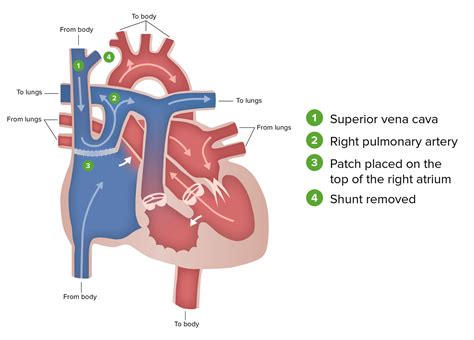 Tricuspid Valve Atresia Tva Concise Medical Knowledge