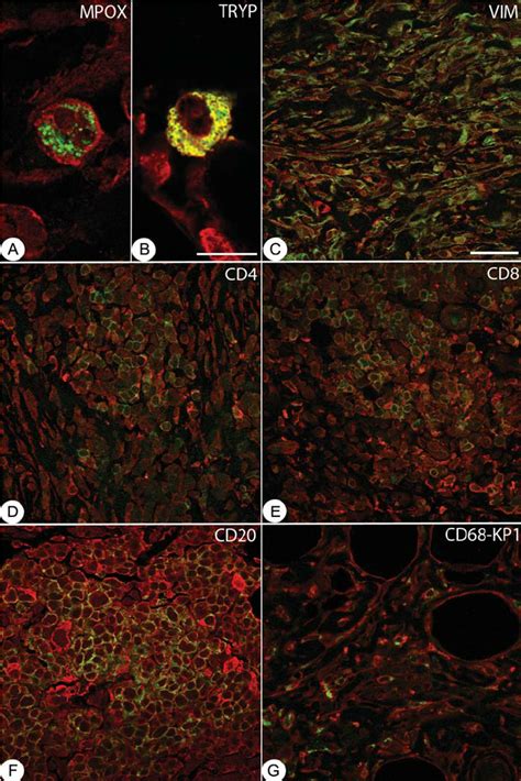 Ccr3 Expression In Retroperitoneal Biopsies Ccr3 Is Stained Red While