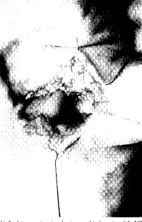 Figure 2 from Irreducible MP Joint Dislocation Due to Entrapment of FPL ...