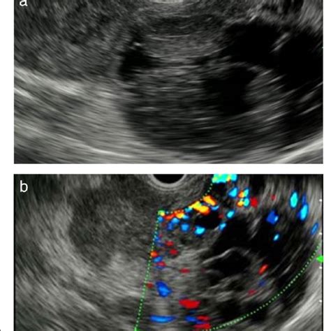 Endoscopic Ultrasonography Eus Findings A Eus Revealed A Download Scientific Diagram