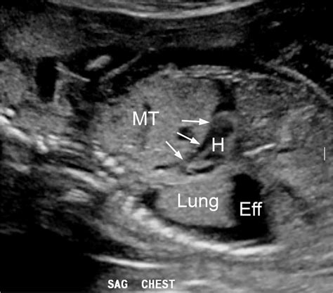 A sagittal gray-scale ultrasound image in a 21-week fetus with ...