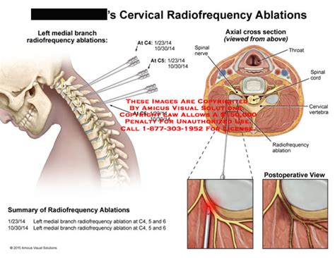 AMICUS Illustration Of Amicus Surgery Cervical Radiofrequency Ablation