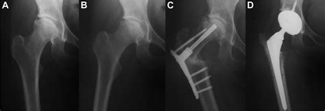 Curved Intertrochanteric Varus Osteotomy Vs Total Hip Arthroplasty For