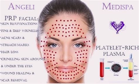 Platelet Rich Plasma Therapy Prp Greater London Angeli Medispa