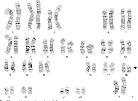 Figure 2 From A Case Of 18p Deletion Syndrome After Blepharoplasty Semantic Scholar