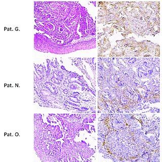 Histology And Pd L Status In Gastric Cancer Patients H E And Ihc