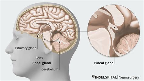 Pineal Tumor Neurosurgery Inselspital Bern