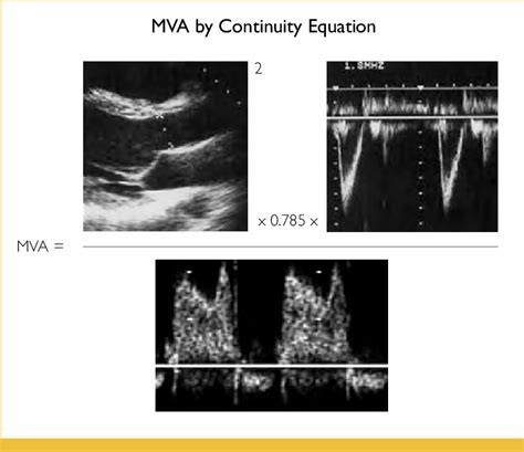 Example Of Calculation Of Mitral Valve Area By Continuity Equation