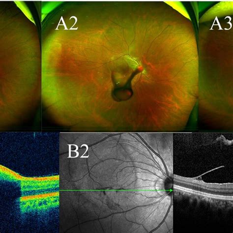 Case 13: a case with Valsalva retinopathy. Examinations were performed ...