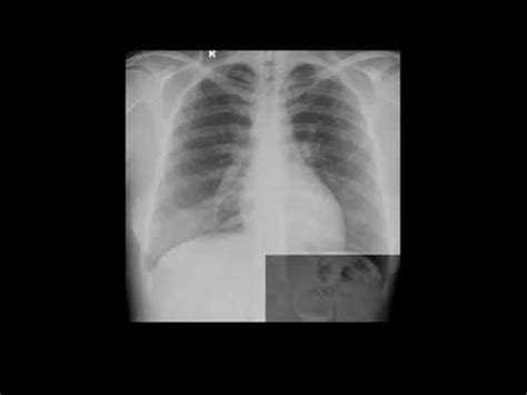 Consolida O Pulmonar O Que E Como Feito O Exame De Rx De T Rax