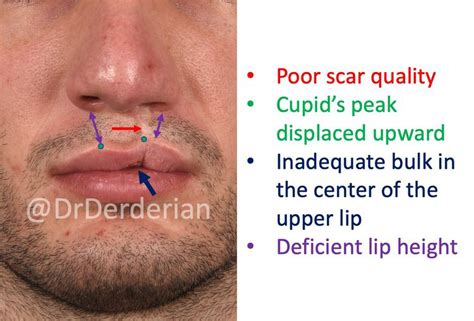 Adult Cleft Rhinoplasty And Cleft Lip Revision — Dr Derderian — Plastic